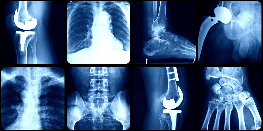 car accident injuries xrays